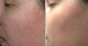 Photofacial Before and After