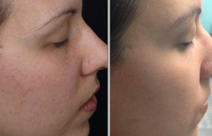 Photofacial Before and After 