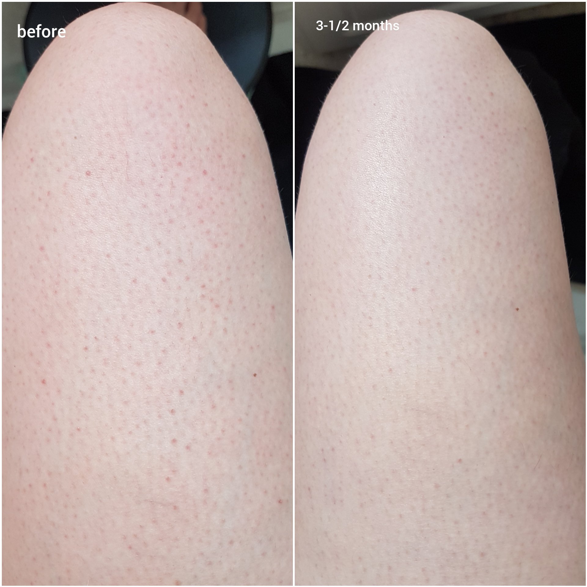 First Aid Beauty KP Bump Eraser Body Scrub Review Raiyne On Beauty first-aid-beauty-kp-bump-eraser-body-scrub-review-raiyne-on-beauty